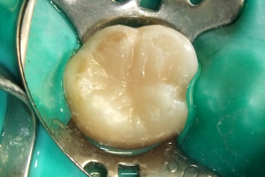 What Is Composite Restoration Filling Globaldentalpro