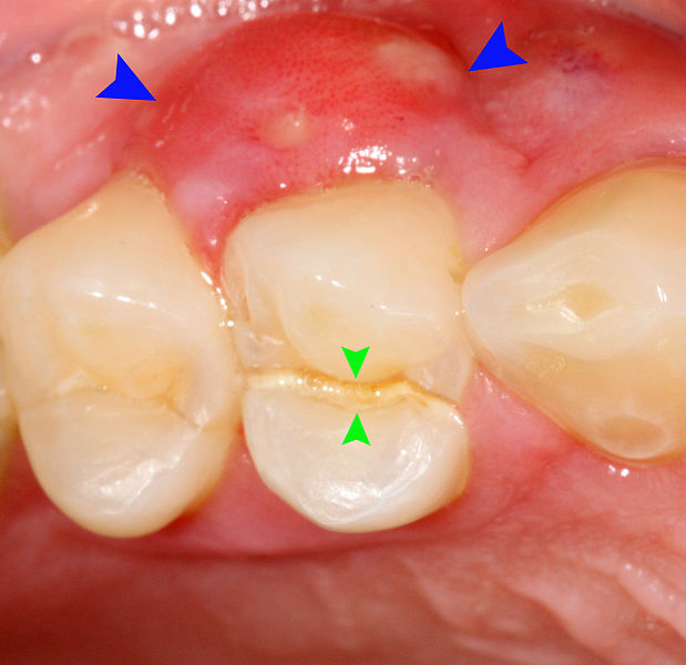 periapical abscess